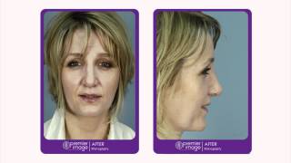 Testimonial – Rhinoplasty – Stephanie