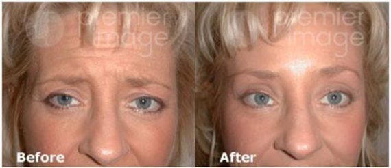 Browlift Before and after photos in Sandy Springs, GA, Patient 15720