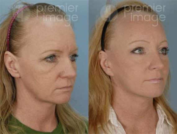 Browlift Before and after photos in Sandy Springs, GA, Patient 15723