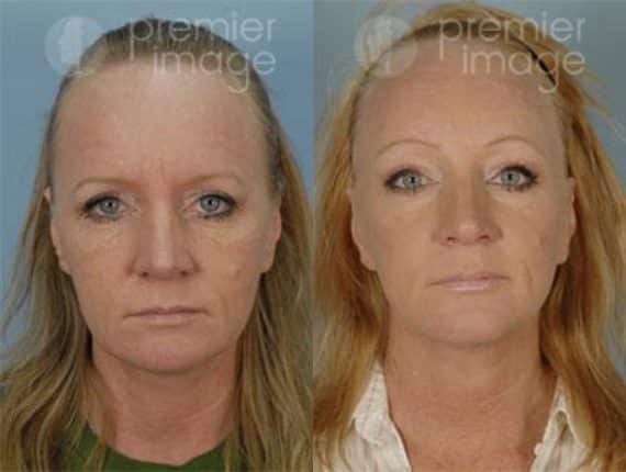 Browlift Before and after photos in Sandy Springs, GA, Patient 15723