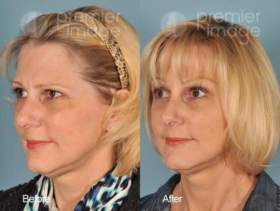 Browlift Before and after photos in Sandy Springs, GA, Patient 15728