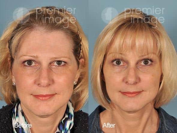 Browlift Before and after photos in Sandy Springs, GA, Patient 15728