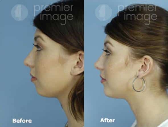 Chin Augmentation Before and after photos in Sandy Springs, GA, Patient 15735