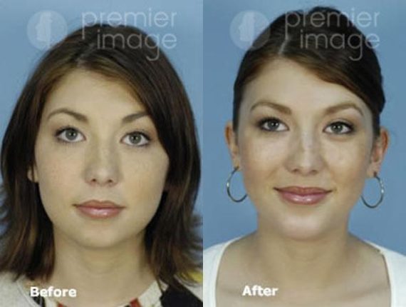 Chin Augmentation Before and after photos in Sandy Springs, GA, Patient 15735