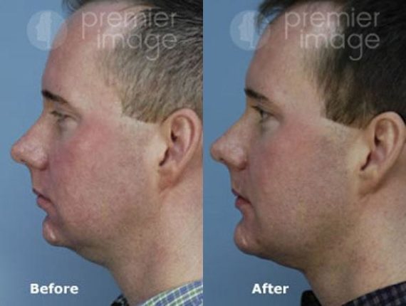 Chin Augmentation Before and after photos in Sandy Springs, GA, Patient 15740