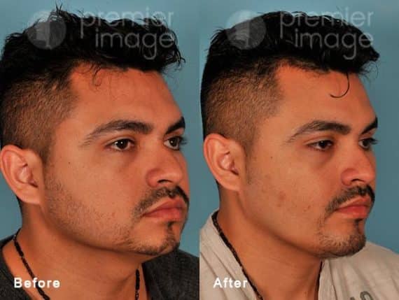 Chin Augmentation Before and after photos in Sandy Springs, GA, Patient 15743