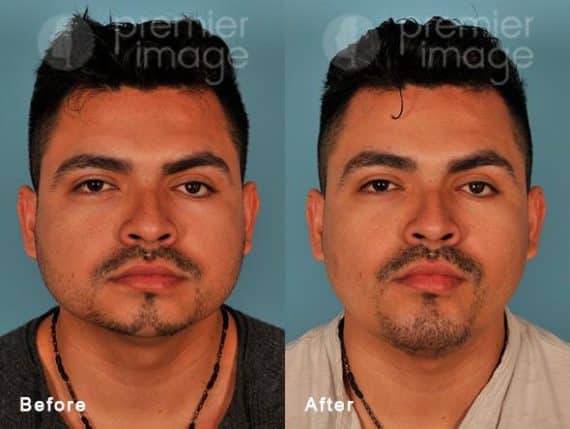 Chin Augmentation Before and after photos in Sandy Springs, GA, Patient 15743