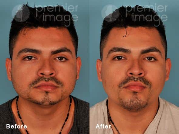 Chin Augmentation Before and after photos, Sandy Springs, GA