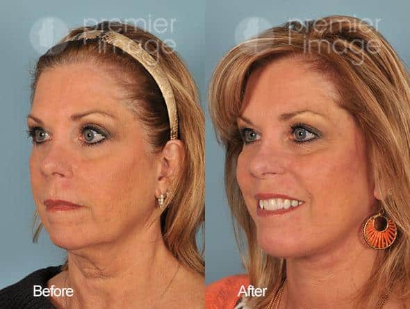 Chin Augmentation Before and after photos in Sandy Springs, GA, Patient 15750