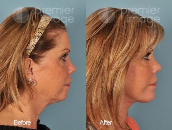 Chin Augmentation Before and after photos in Sandy Springs, GA, Patient 15750