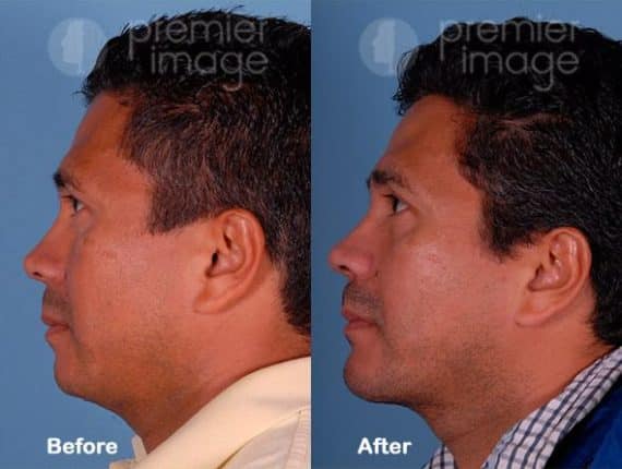 Chin Augmentation Before and after photos in Sandy Springs, GA, Patient 15757