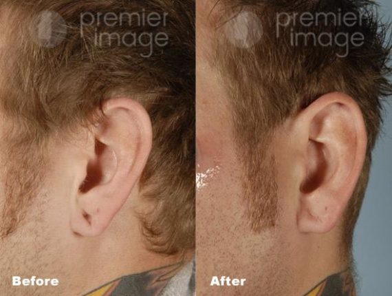 Earlobe Repair Before and after photos in Sandy Springs, GA, Patient 15760