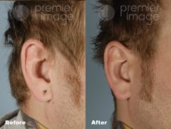 Earlobe Repair Before and after photos in Sandy Springs, GA, Patient 15760