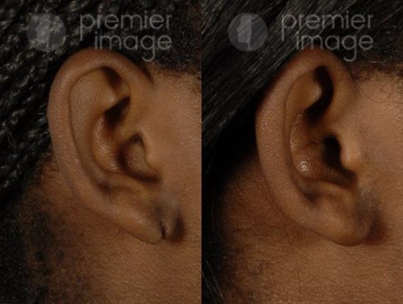 Earlobe Repair Before and after photos in Sandy Springs, GA, Patient 15765