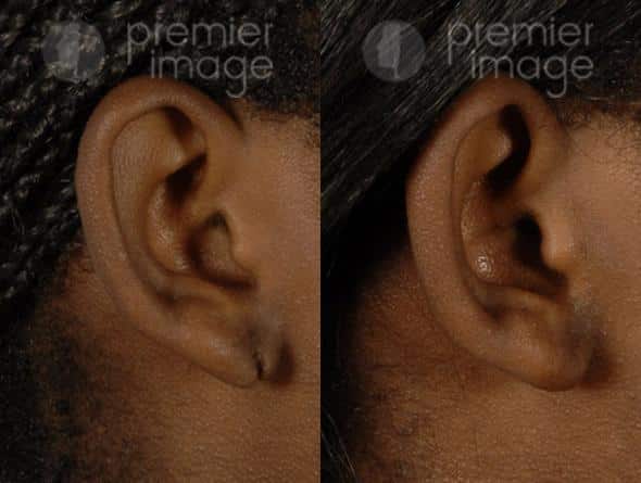 Earlobe Repair Atlanta, GA