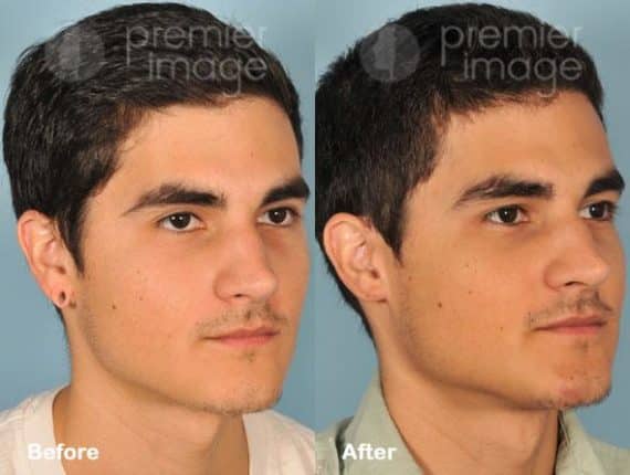 Earlobe Repair Before and after photos in Sandy Springs, GA, Patient 15768