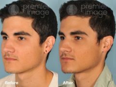 Earlobe Repair Before and after photos in Sandy Springs, GA, Patient 15768