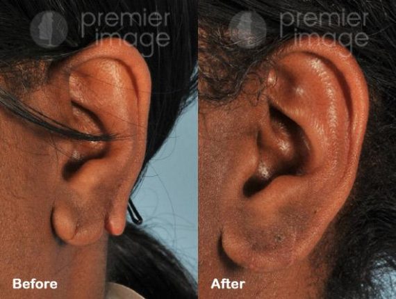 Earlobe Repair Before and after photos in Sandy Springs, GA, Patient 15773