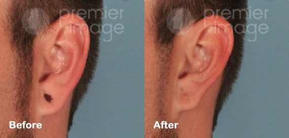 Earlobe Repair Before and after photos in Sandy Springs, GA, Patient 15776