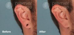 Earlobe Repair Before and after photos in Sandy Springs, GA, Patient 15776