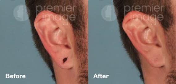 Earlobe Repair Before and after photos in Sandy Springs, GA, Patient 15776