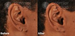 Earlobe Repair Before and after photos in Sandy Springs, GA, Patient 15781