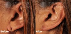 Earlobe Repair Before and after photos in Sandy Springs, GA, Patient 15784