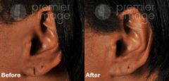 Earlobe Repair Before and after photos in Sandy Springs, GA, Patient 15787