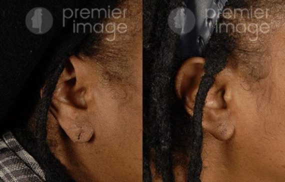 Earlobe Repair Before and after photos in Sandy Springs, GA, Patient 15790