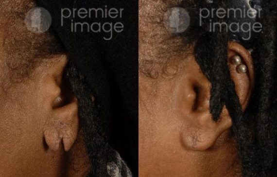 Earlobe Repair Before and after photos in Sandy Springs, GA, Patient 15790