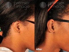 Earlobe Repair Before and after photos in Sandy Springs, GA, Patient 15795