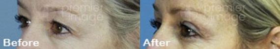 Eyelid Surgery (Blepharoplasty) Before and after photos in Sandy Springs, GA, Patient 15798