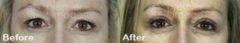 Eyelid Surgery (Blepharoplasty) Before and after photos in Sandy Springs, GA, Patient 15798