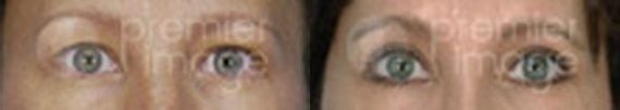 Eyelid Surgery (Blepharoplasty) Before and after photos in Sandy Springs, GA, Patient 15803