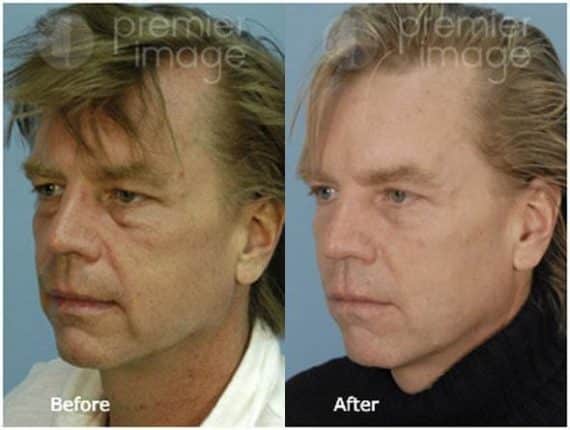 Eyelid Surgery (Blepharoplasty) Before and after photos in Sandy Springs, GA, Patient 15806