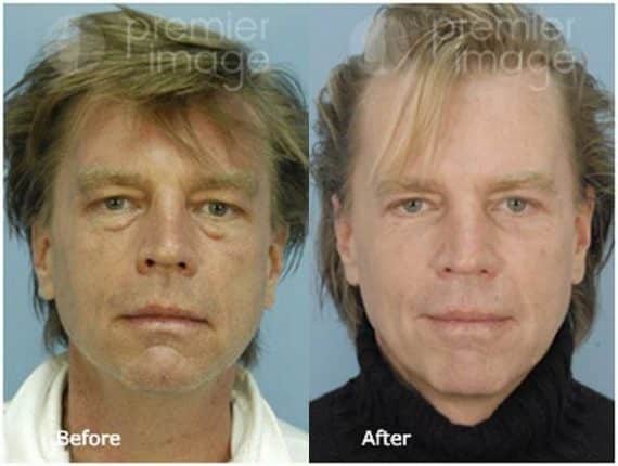 Eyelid Surgery (Blepharoplasty) Before and after photos in Sandy Springs, GA, Patient 15806