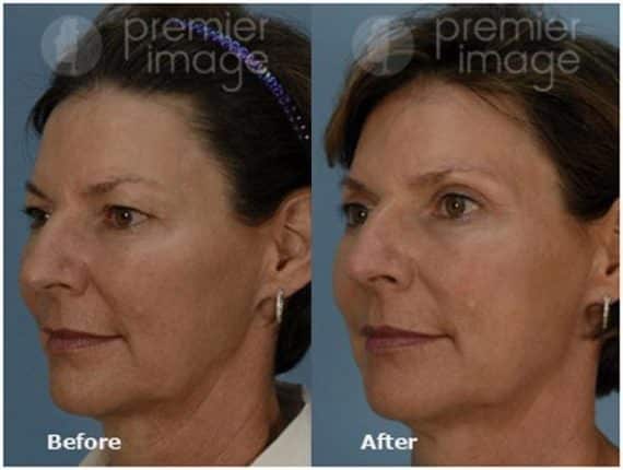 Eyelid Surgery (Blepharoplasty) Before and after photos in Sandy Springs, GA, Patient 15813