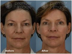 Eyelid Surgery (Blepharoplasty) Before and after photos in Sandy Springs, GA, Patient 15813