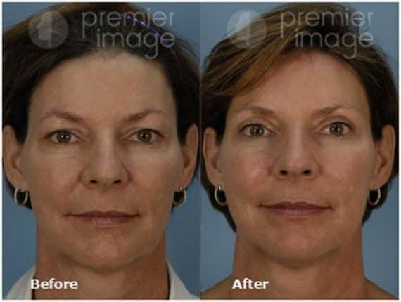 Eyelid Surgery (Blepharoplasty) Before and after photos in Sandy Springs, GA, Patient 15813