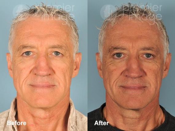 Eyelid Surgery (Blepharoplasty) Before and after photos in Sandy Springs, GA, Patient 15820