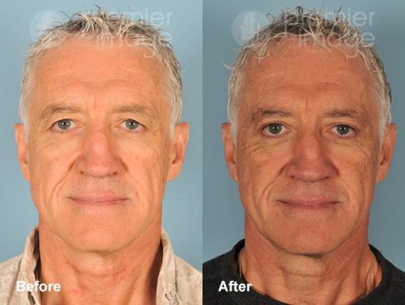 Eyelid Surgery (Blepharoplasty) Before and after photos in Sandy Springs, GA, Patient 15820