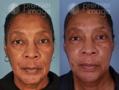 Eyelid Surgery (Blepharoplasty) Before and after photos in Sandy Springs, GA, Patient 15823