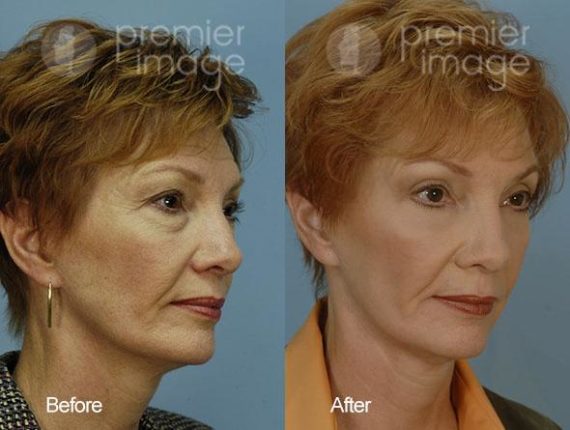 Eyelid Surgery (Blepharoplasty) Before and after photos in Sandy Springs, GA, Patient 15826