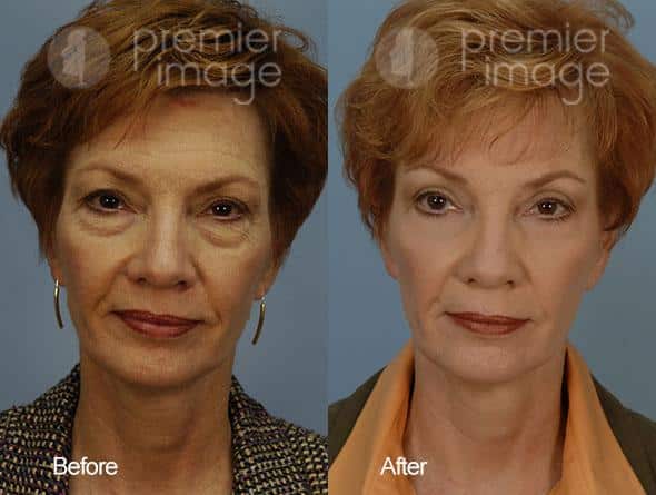 Eyelid Surgery (Blepharoplasty) Before and after photos in Sandy Springs, GA, Patient 15826