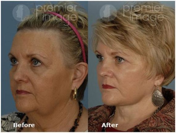 Facelift and Necklift Before and after photos in Sandy Springs, GA, Patient 15831