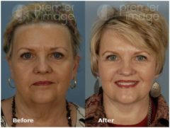 Facelift and Necklift Before and after photos in Sandy Springs, GA, Patient 15831