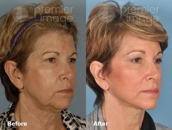 Facelift and Necklift Before and after photos in Sandy Springs, GA, Patient 15838