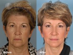 Facelift and Necklift Before and after photos in Sandy Springs, GA, Patient 15838