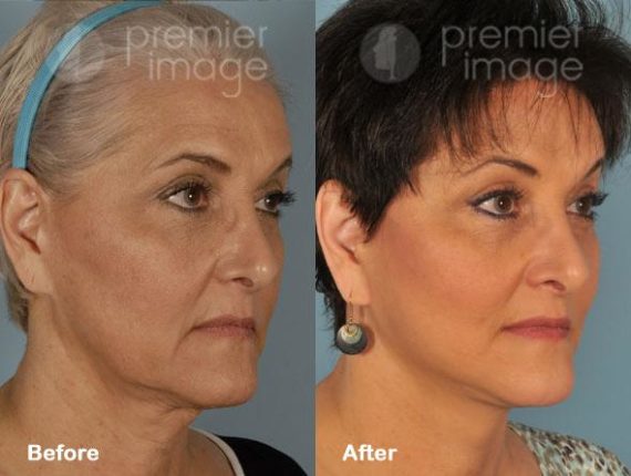 Facelift and Necklift Before and after photos in Sandy Springs, GA, Patient 15843