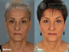 Facelift and Necklift Before and after photos in Sandy Springs, GA, Patient 15843